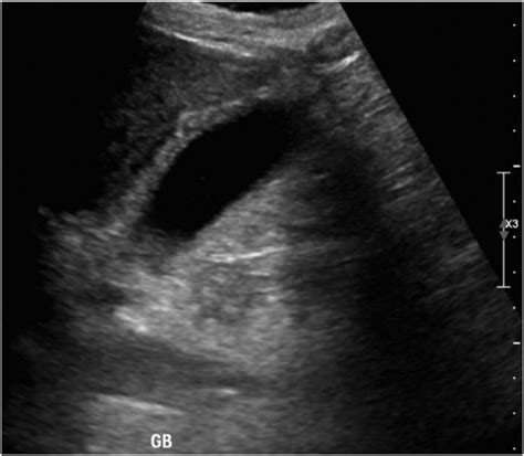 best location to measure gallbladder wall thickness|ultrasound for gallbladder wall thickening.